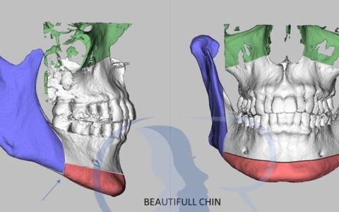 Beauty-Full-Chin Vs Genioplastica: le differenze