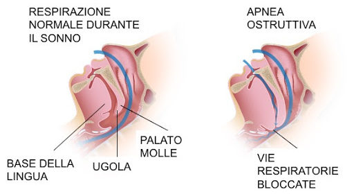 Come curare l’OSAS grazie all’ortognatica