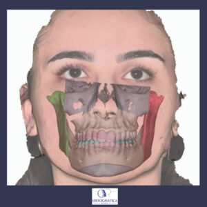 previsualizzazione 3d ortognatica 2