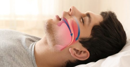 Apnee ostruttive del sonno: quando il problema è di natura dentoscheletrica
