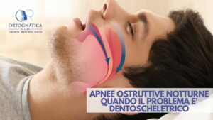 Apnee ostruttive notturne