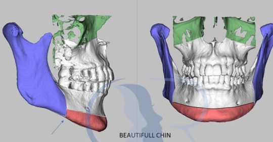 Beauty-Full-Chin Vs Genioplastica: le differenze