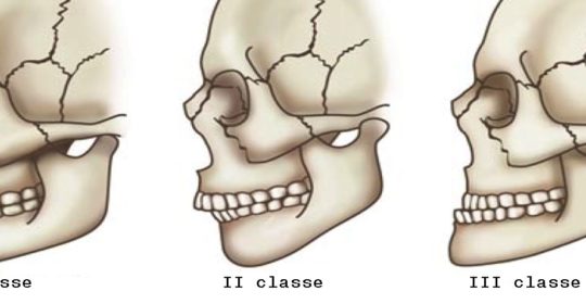 Malocclusione