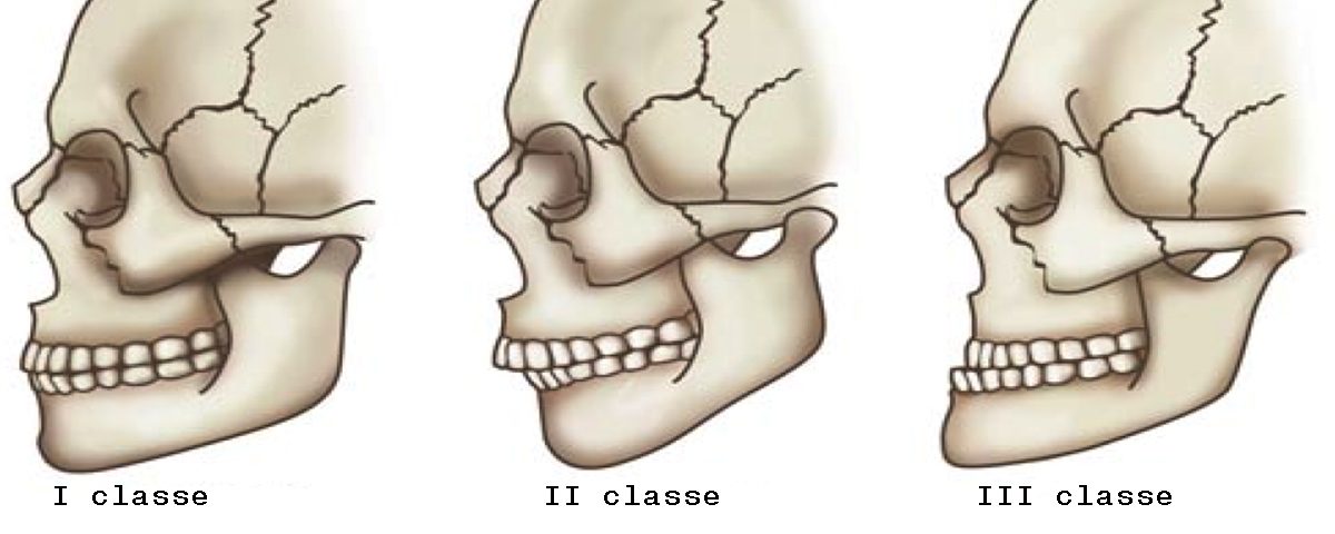 malocclusione