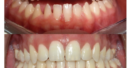 occlusione