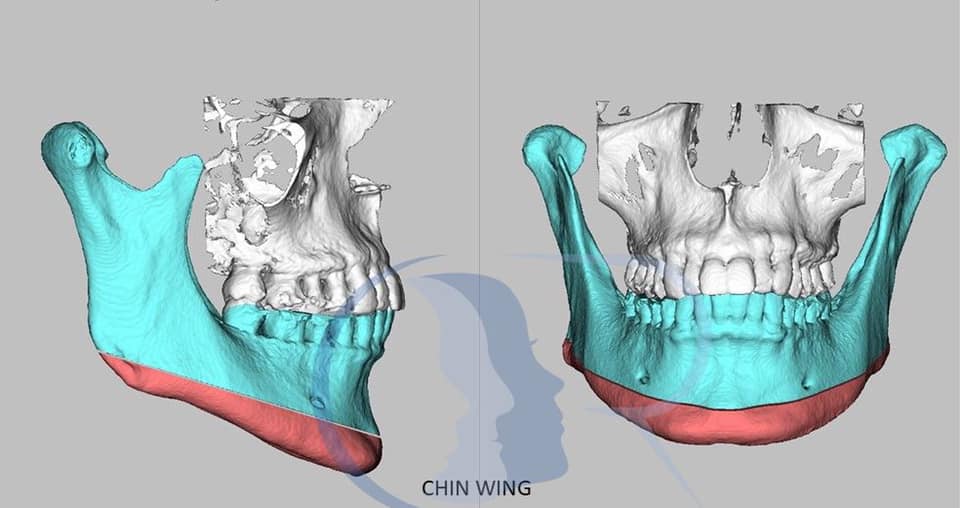 Chin wing