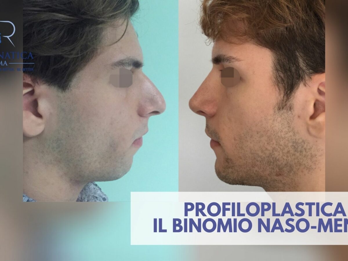 Profiloplastica L Importanza Del Binomio Naso Mento Ortognaticaroma