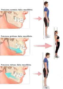 postura malocclusione