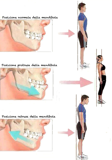 postura malocclusione