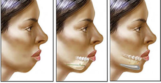 mentoplastica additiva