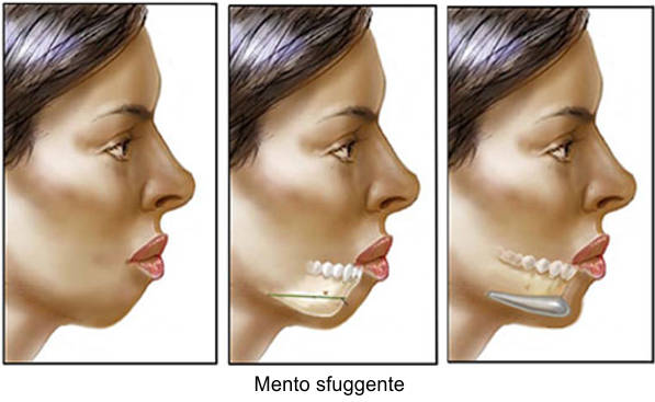 mentoplastica additiva