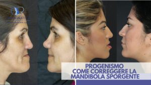 Progenismo