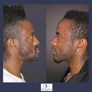 Progenismo, scucchia, mandibola in avanti