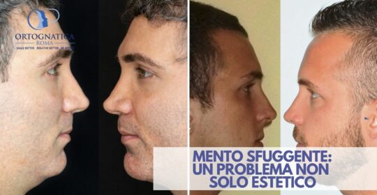 Mento retruso