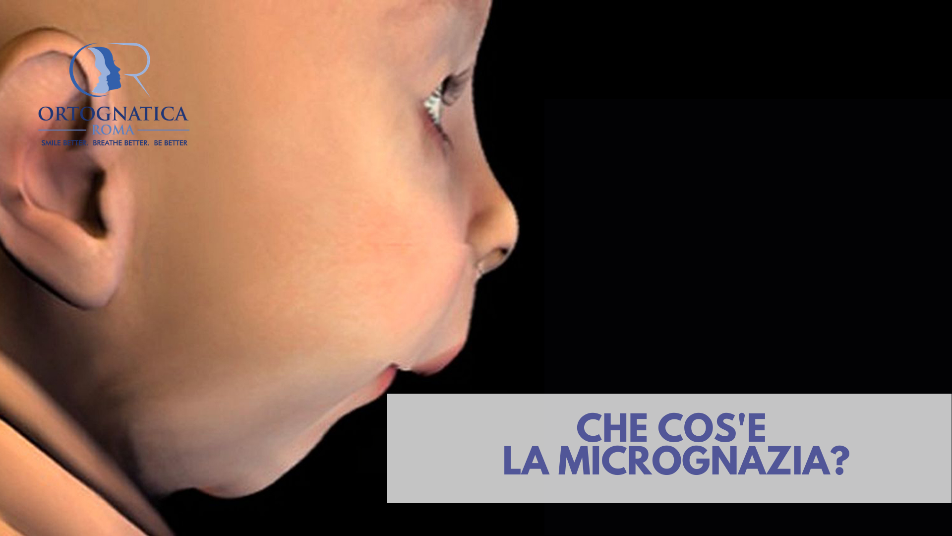 Micrognazia