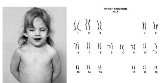 Sindrome di Turner