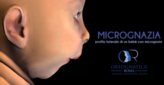 Cos’è la micrognazia