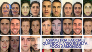 Asimmetria facciale