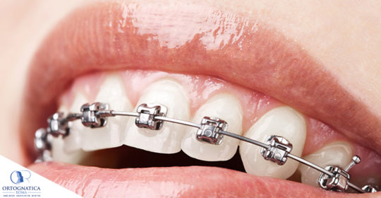 Surgery first e gli altri approcci di ortodonzia in chirurgia ortognatica