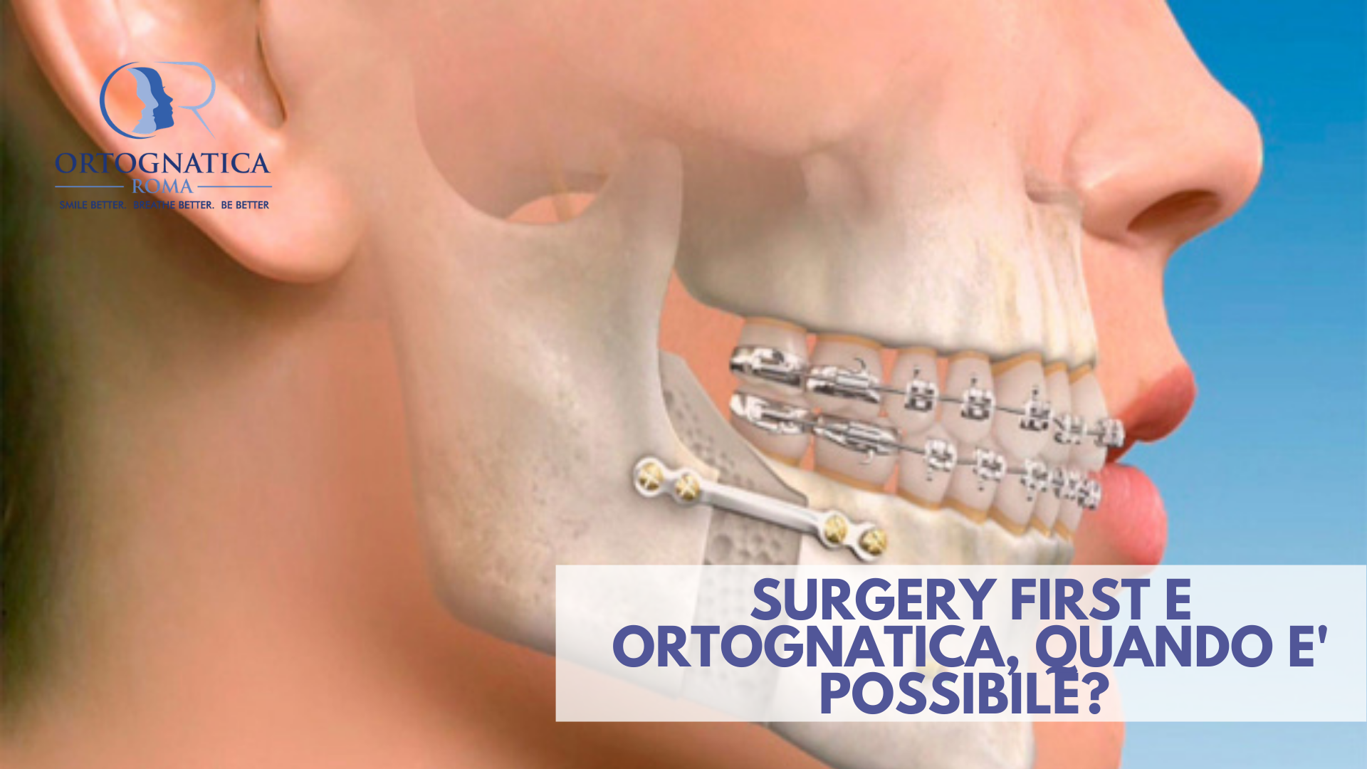 Surgery first e ortognatica