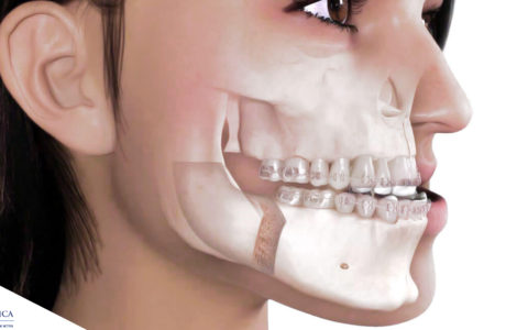 Surgery First e Ortognatica: quando è possibile?