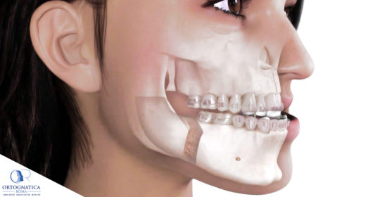 Surgery First e Ortognatica: quando è possibile?