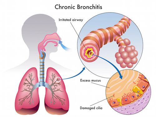 bronchite cronica