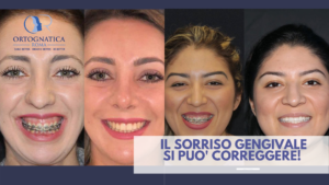 Sorriso gengivale