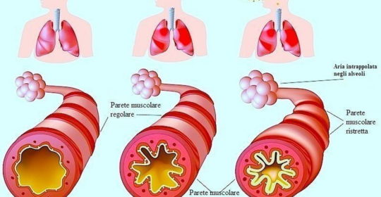Iperreattività bronchiale