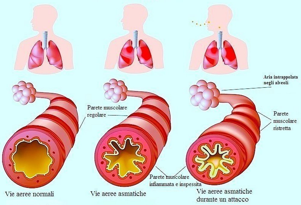 Iperatttività bronchiale