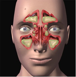 Sindrome rino-sinuso-bronchiale