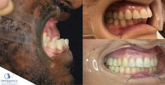 Ortodonzia pre-chirurgica: la decompensazione ortodontica