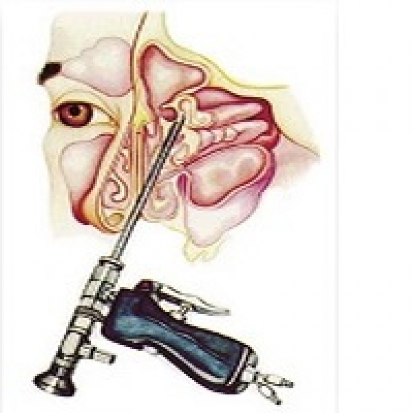 Chirurgia endoscopica nasale