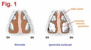 Ipertrofia dei turbinati