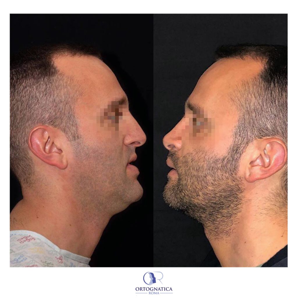 Genioplastica: come rifare il mento - OrtognaticaRoma