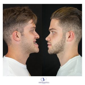 Progenismo, scucchia, mandibola in avanti