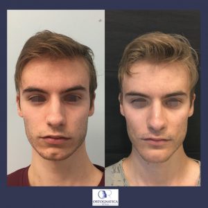 face masculinization 