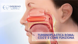 Turbinoplastica Roma