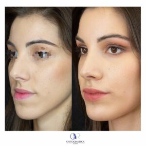 Face Feminilization Surgery