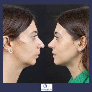 Face make over bimascellare