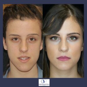 Femminilizzazione del viso
