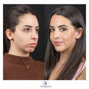 Femminilizzazione del viso