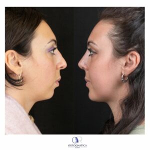 Femminilizzazione del viso