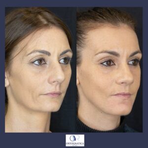 Femminilizzazione del volto