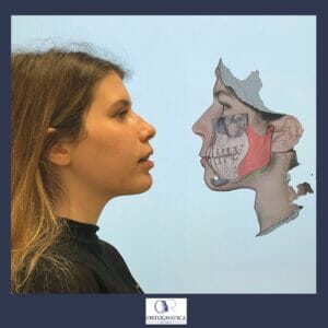 La pianificazione 3d in chirurgia ortognatica 