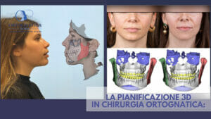 La pianificazione 3d in chirurgia ortognatica