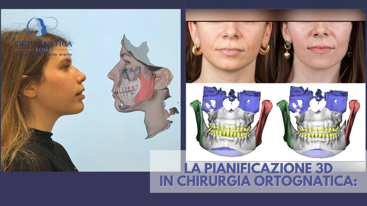 La pianificazione 3d in chirurgia ortognatica