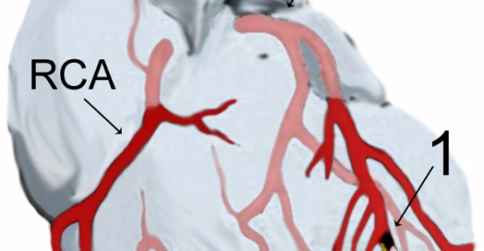 Infarto miocardico acuto