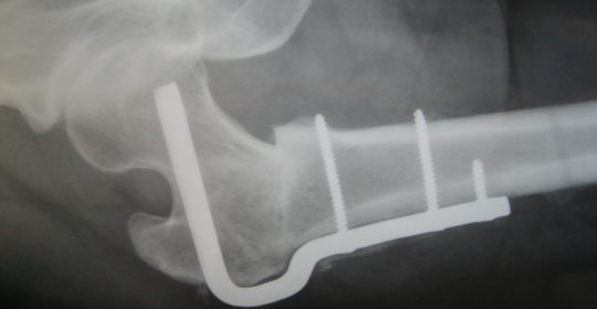 osteotomia